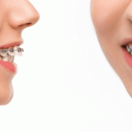 Alasan Pasang Kawat Gigi yang Lebih Penting Dari Sekedar Meratakan Gigi